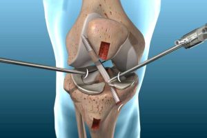 Know About The Knee Replacement Surgery Cost In India