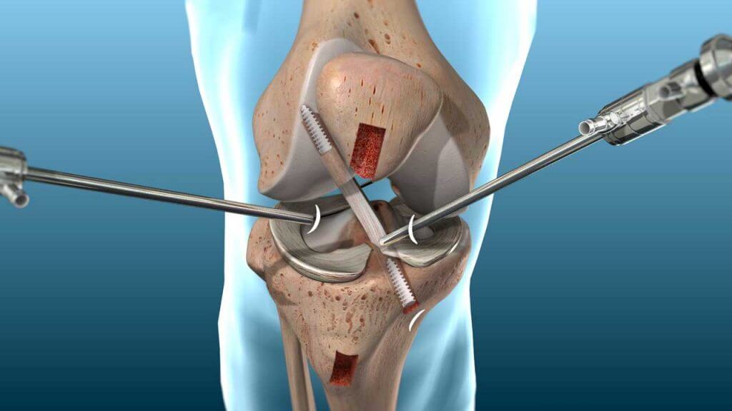 Know About The Knee Replacement Surgery Cost In India