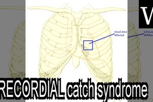 Precordial Catch Syndrome Symptoms