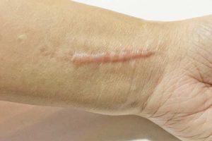 Defeat Scars At Home