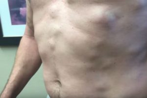 Lipoma treatment in Homeopathy