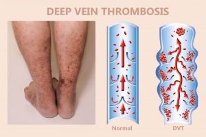 Signs of Deep Vein Thrombosis And Its Treatment