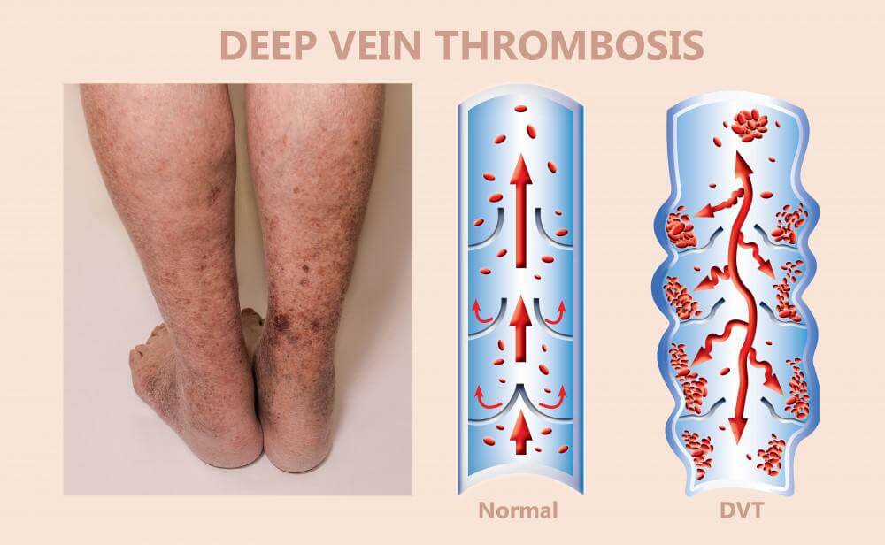 Signs of Deep Vein Thrombosis And Its Treatment