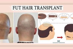 Facts About FUE Hair Transplant