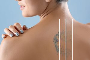 Laser Tattoo Removal
