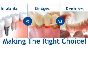 Options For Replacing Missing Teeth