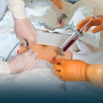 Side Effects of Stem Cell or Bone Marrow Transplant