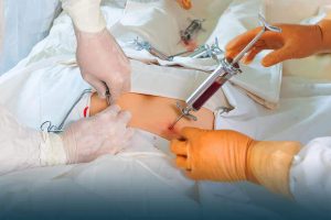 Side Effects of Stem Cell or Bone Marrow Transplant