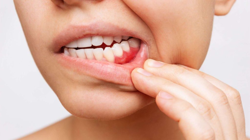 What Are The Causes Of Bleeding Gums