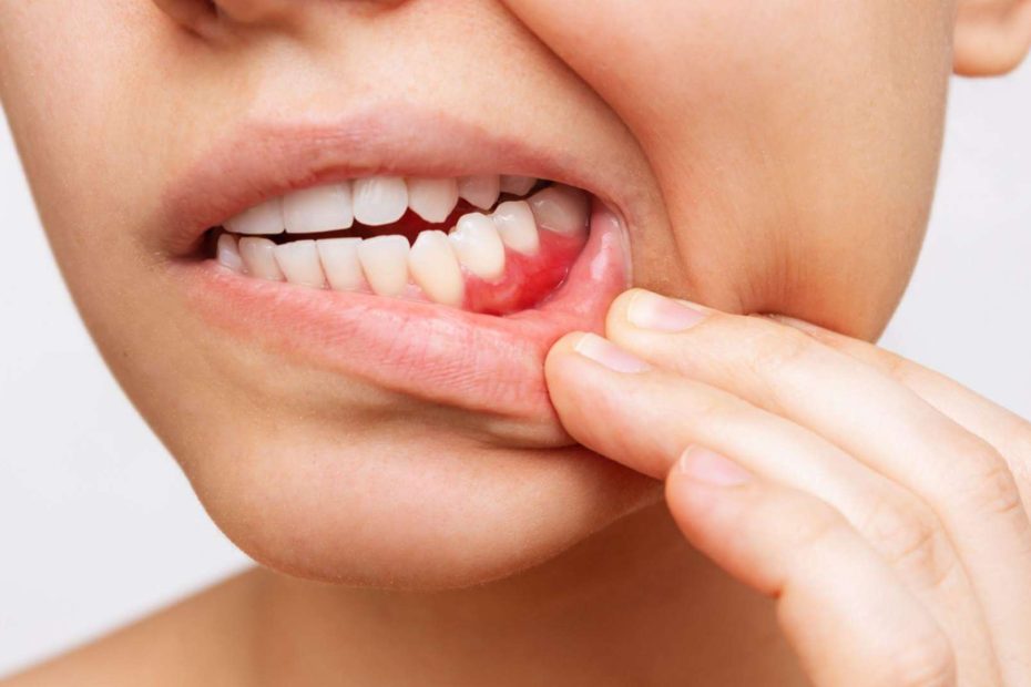 What Are The Causes Of Bleeding Gums