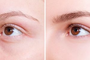 What is Eyebrow Restoration