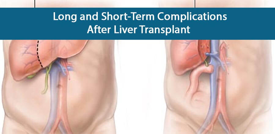 Liver Transplant Complications for Liver donors