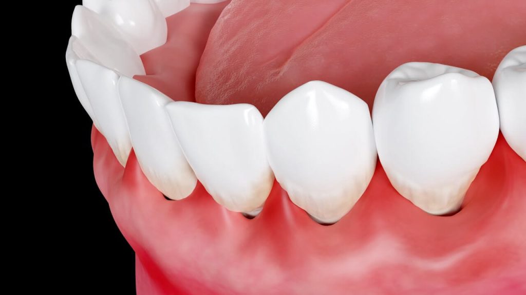 What Causes Swollen Gums And How To Treat