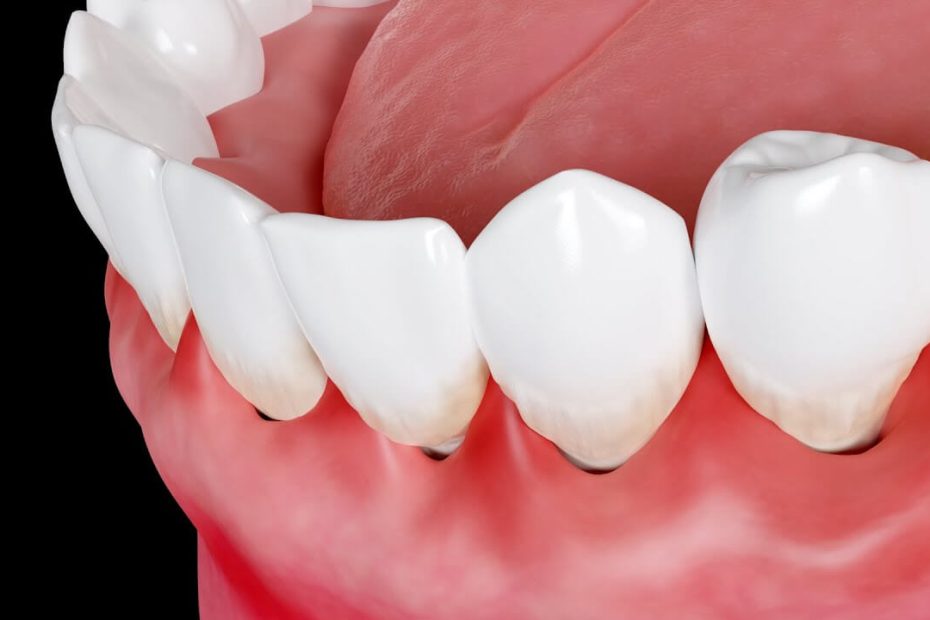What Causes Swollen Gums And How To Treat