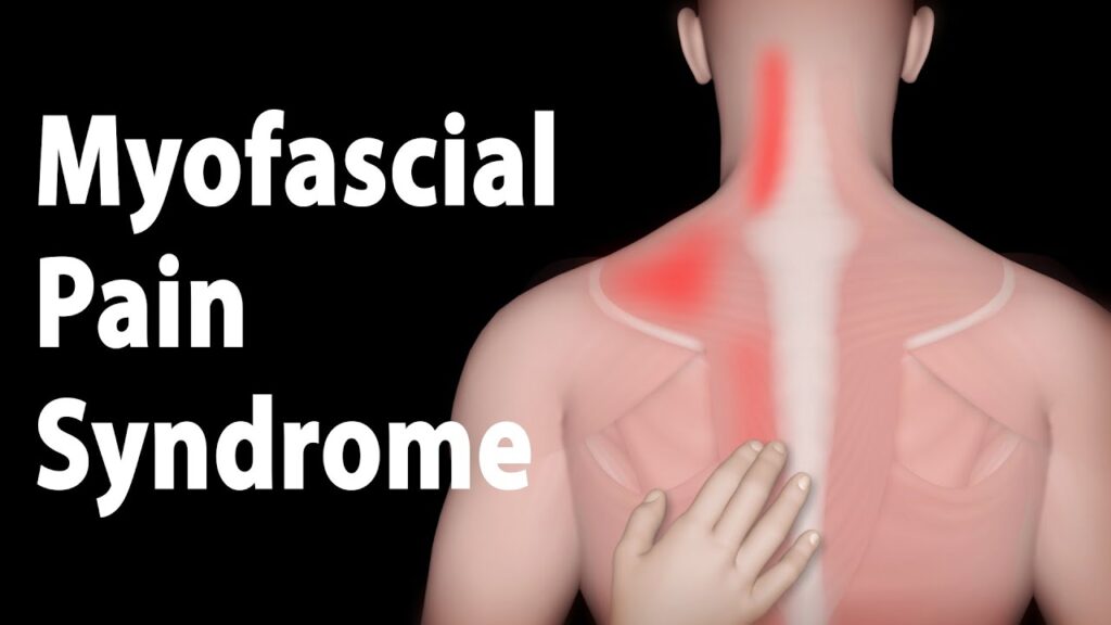 Myofascial Pain