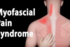 Myofascial Pain
