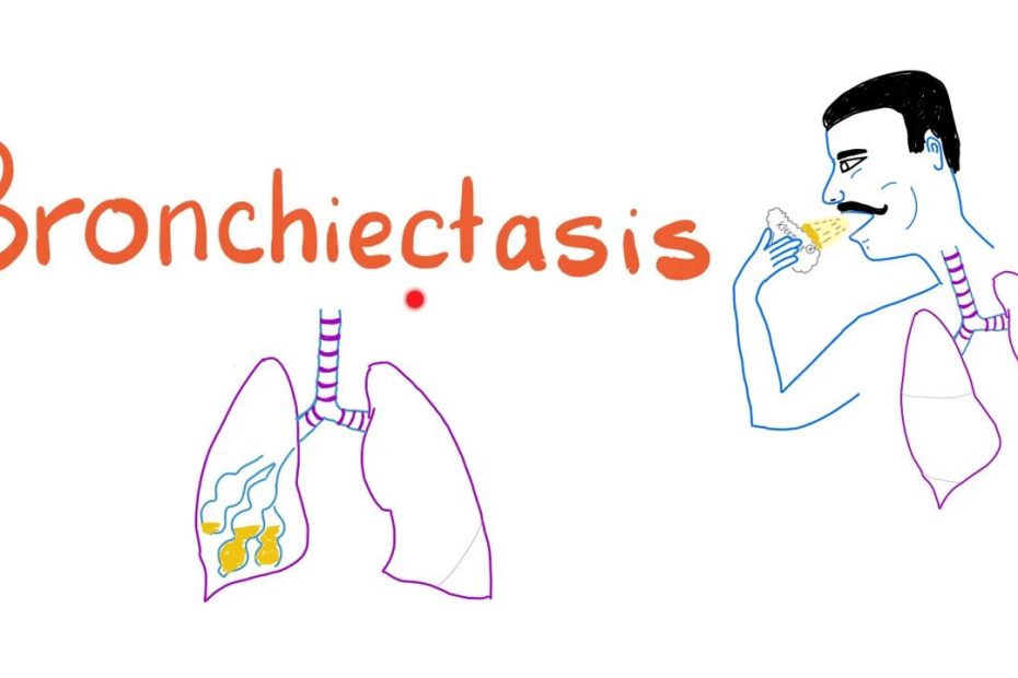 Bronchiectasis