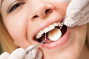 Professional Teeth Cleaning