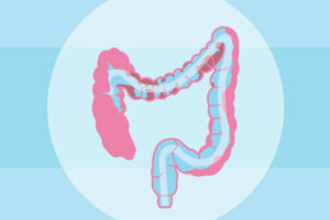 Colon Hydrotherapy