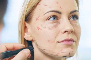 Facelift Surgery