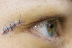 Absorbable Sutures