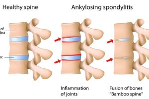 Homeopathic Medicine for Ankylosing Spondylitis