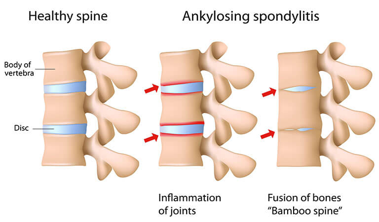 Homeopathic Medicine for Ankylosing Spondylitis