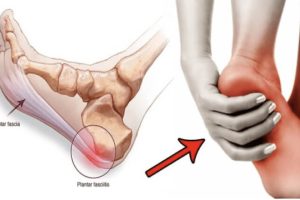 How to Deal with Plantar Fasciitis (1)
