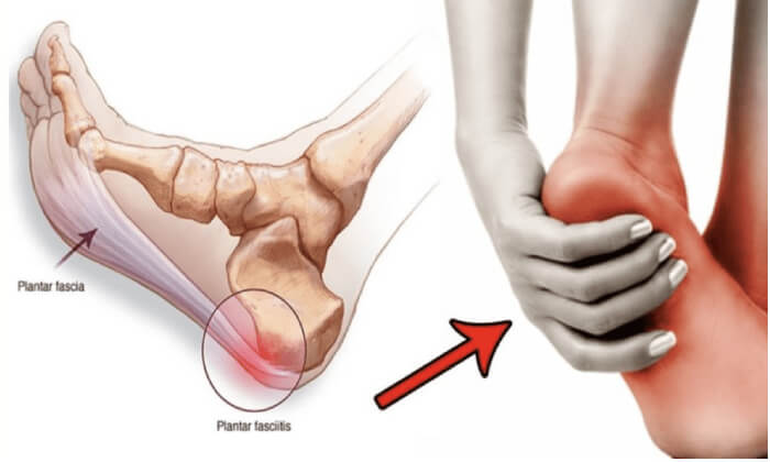 How to Deal with Plantar Fasciitis (1)