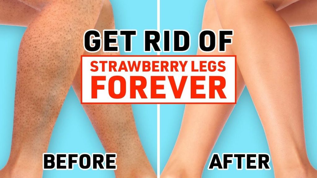 Strawberry Legs Treatment