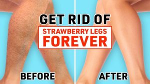 Strawberry Legs Treatment