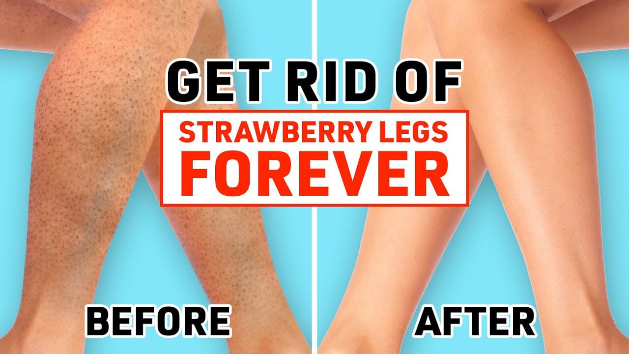 Strawberry Legs Treatment