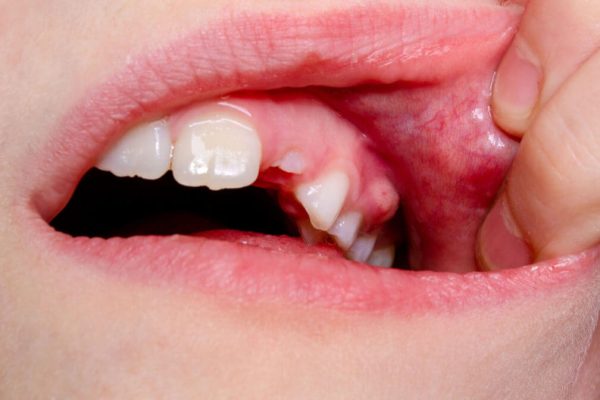 How Long Until a Tooth Infection Kills You