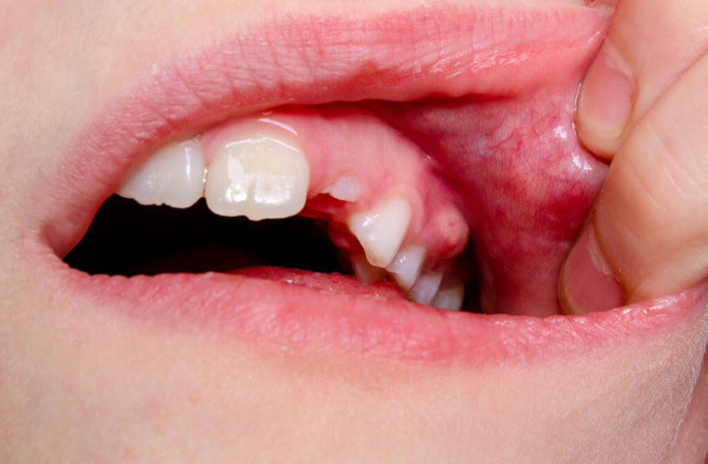 How Long Until a Tooth Infection Kills You