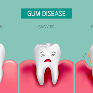 How Long Can You Keep Your Teeth With Periodontal Disease
