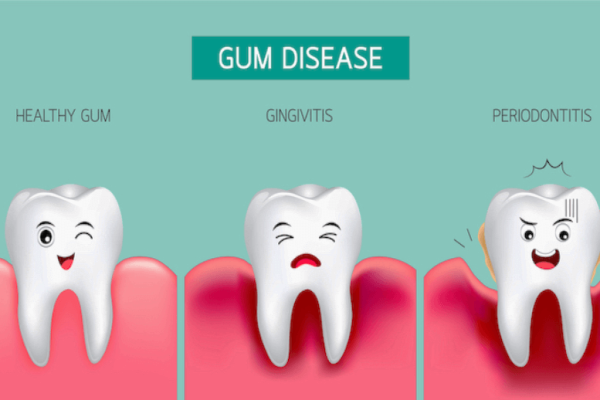 How Long Can You Keep Your Teeth With Periodontal Disease