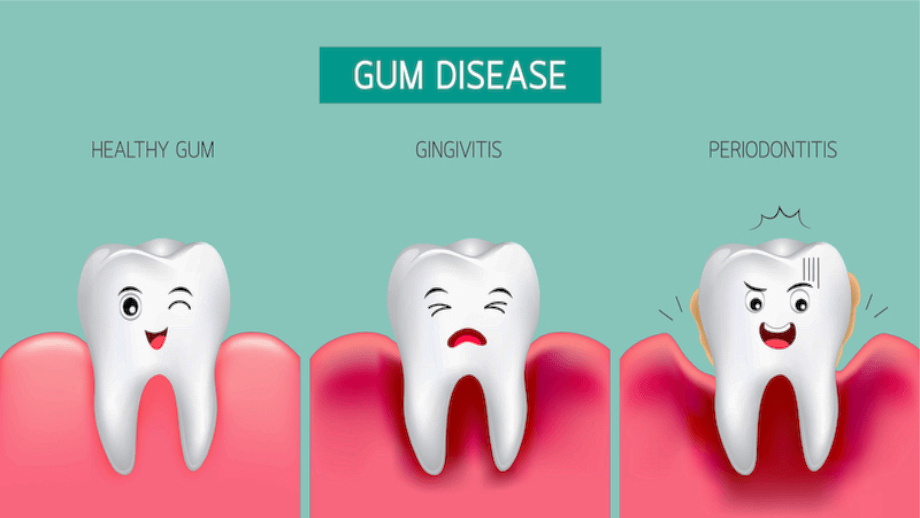 How Long Can You Keep Your Teeth With Periodontal Disease
