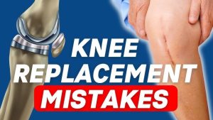 Mistakes After Knee Replacement